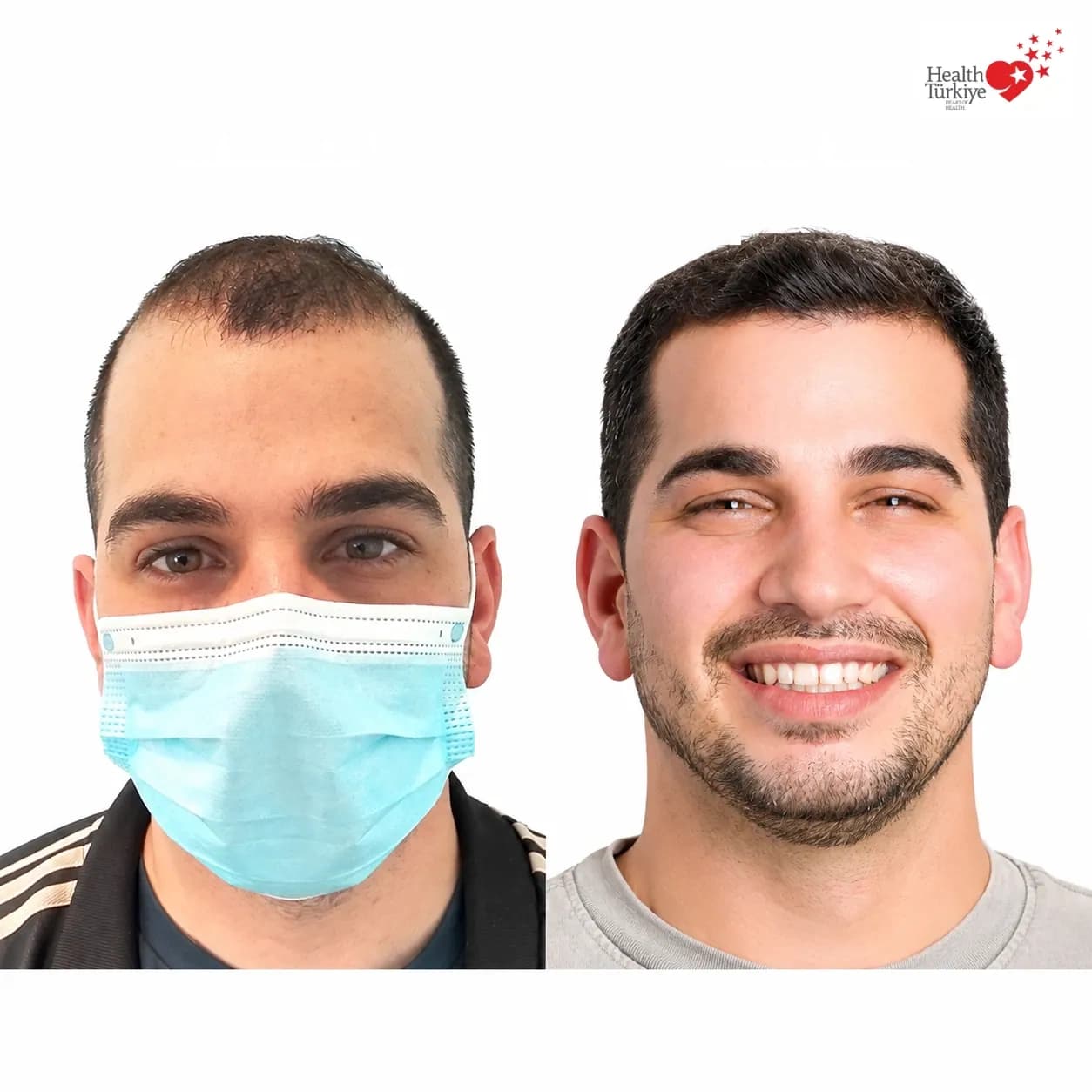 Before and after hair transplantation
