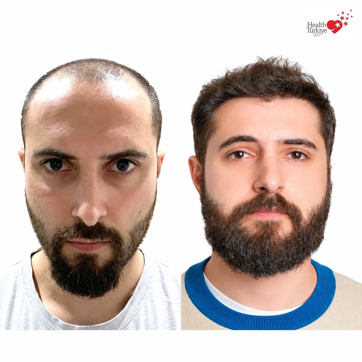 Before and after hair transplantation