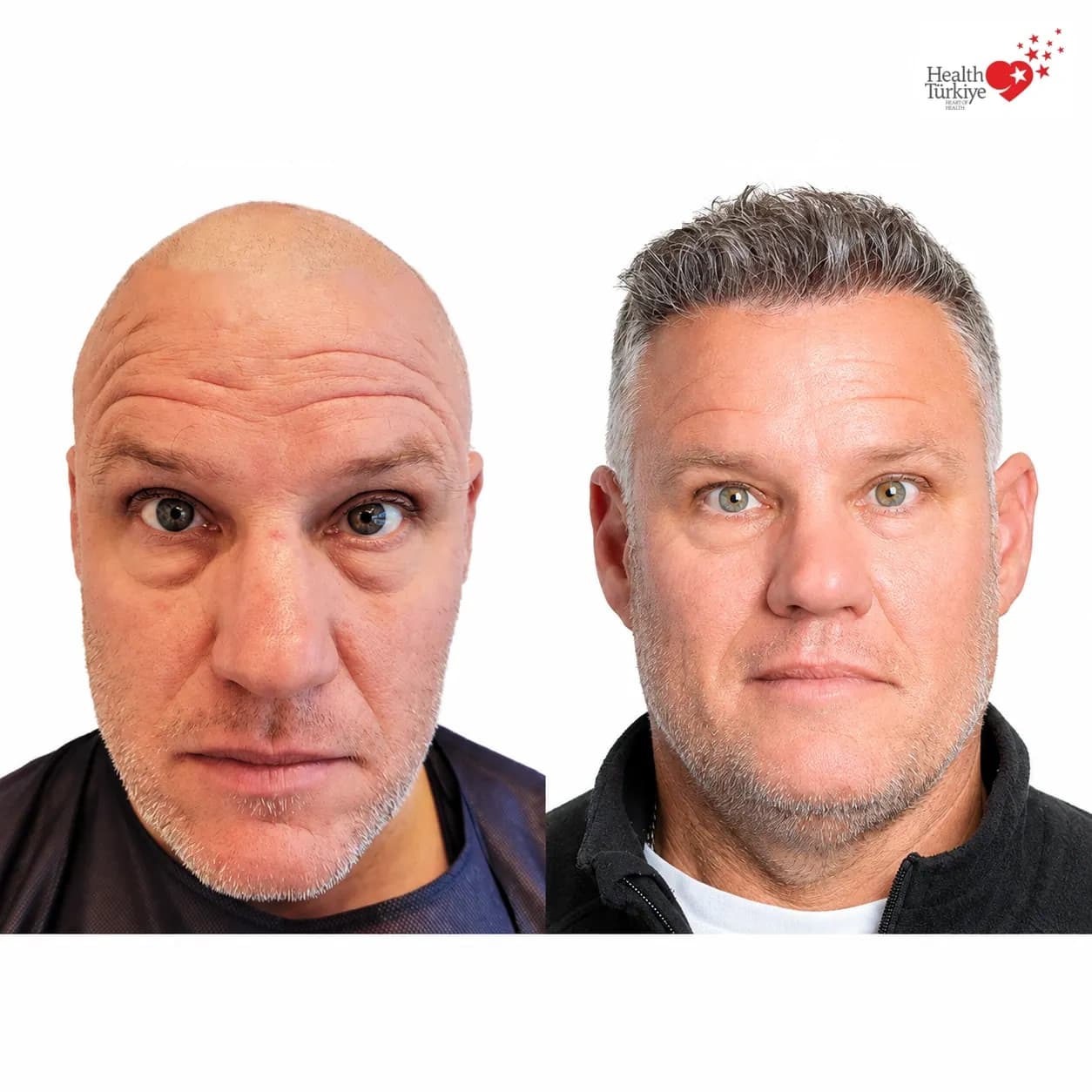 Before and after hair transplantation