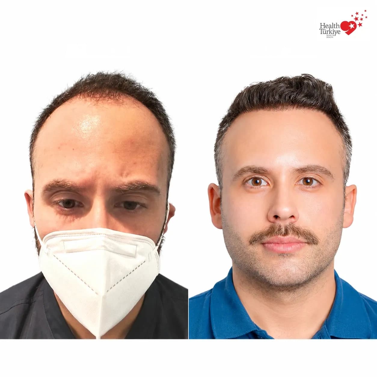 Before and after hair transplantation