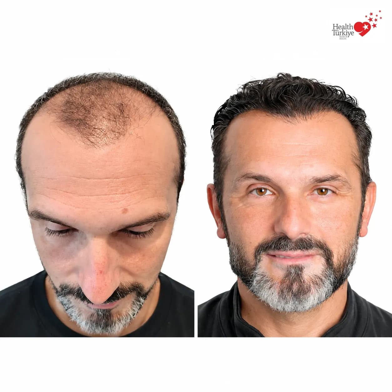 Before and after hair transplantation