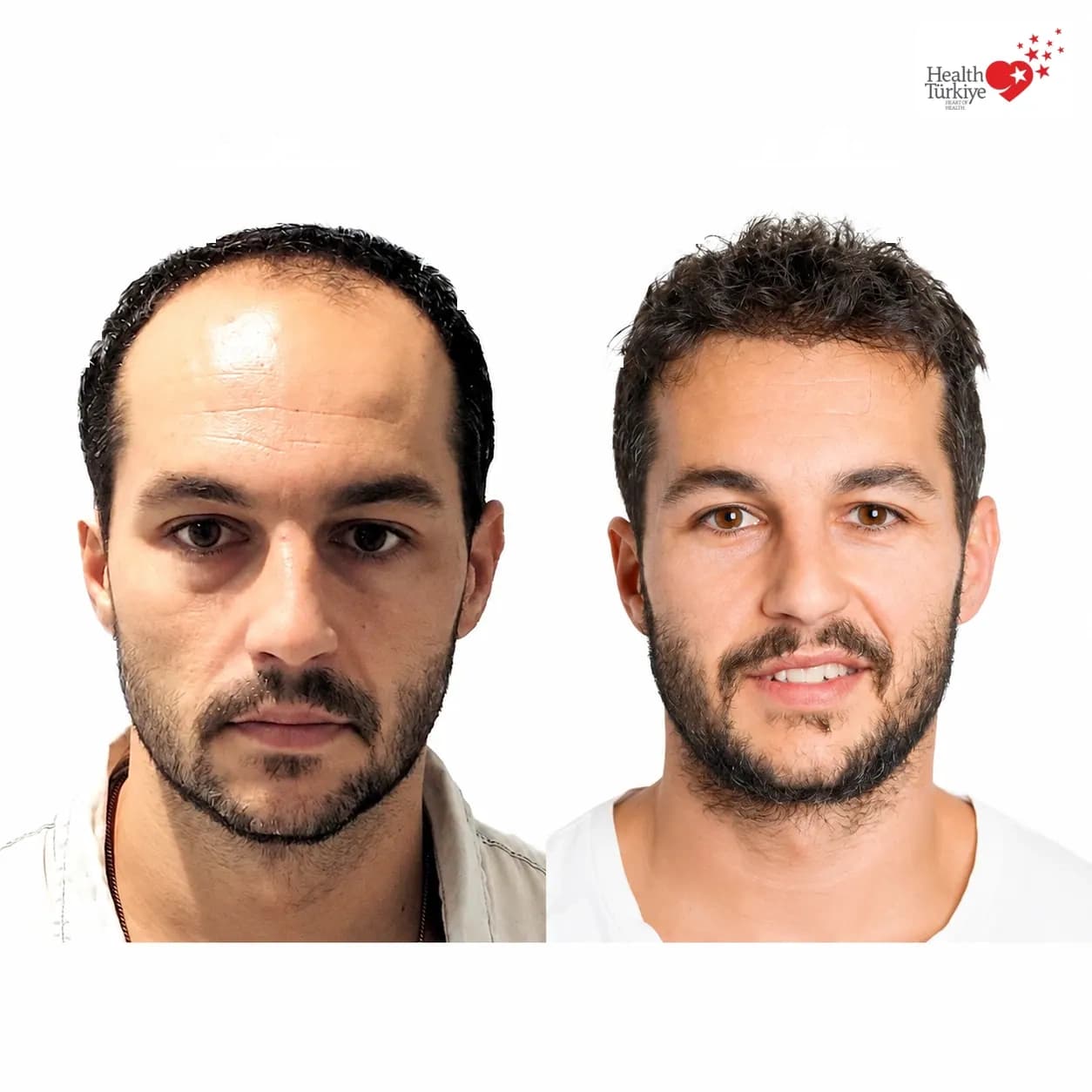 Before and after hair transplantation