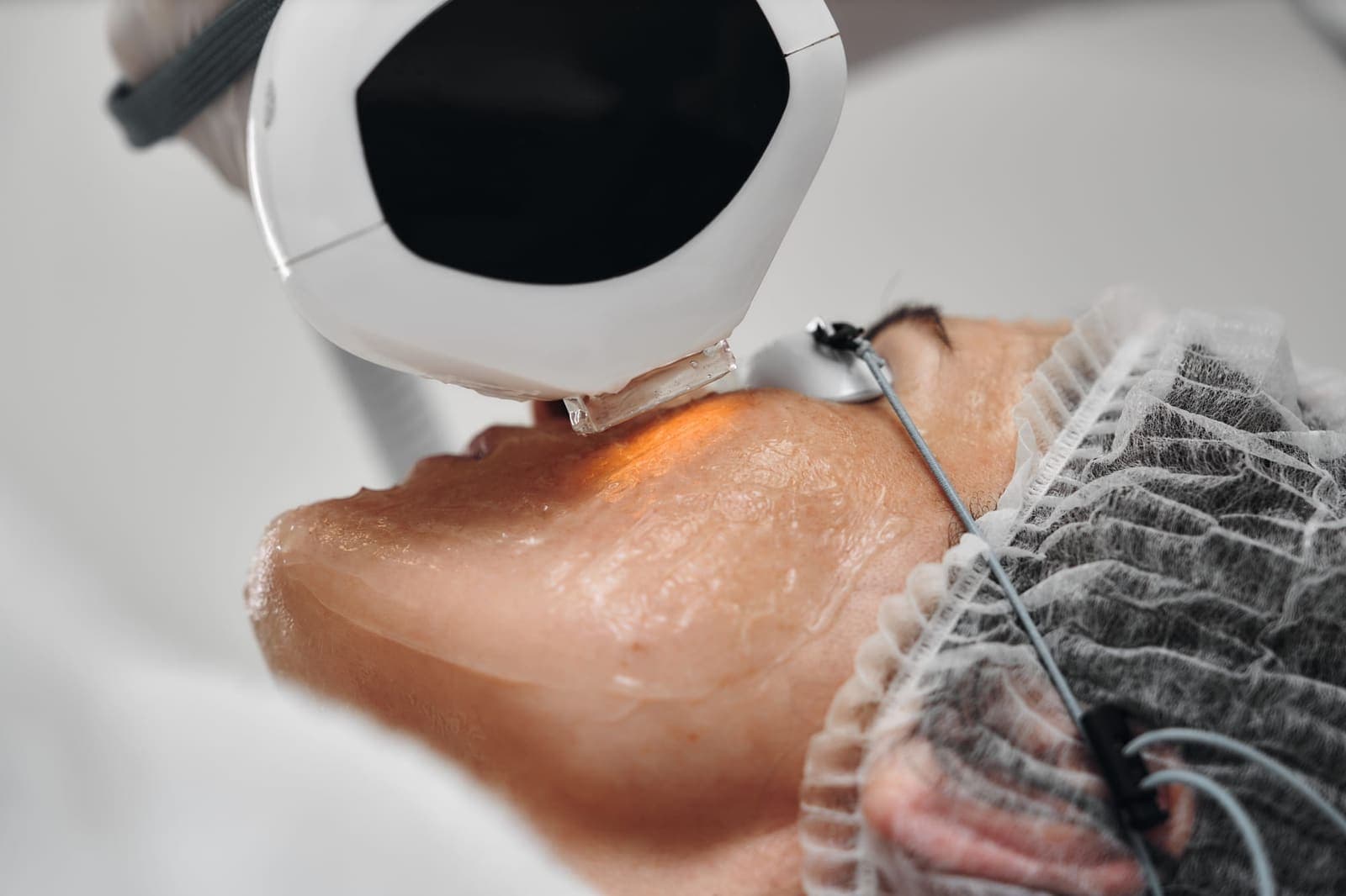 Thulium laser at Renewa Clinic